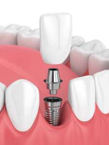 Graphic of a single tooth implant