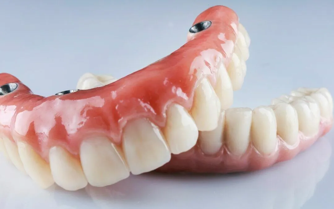 whole mouth dental implants