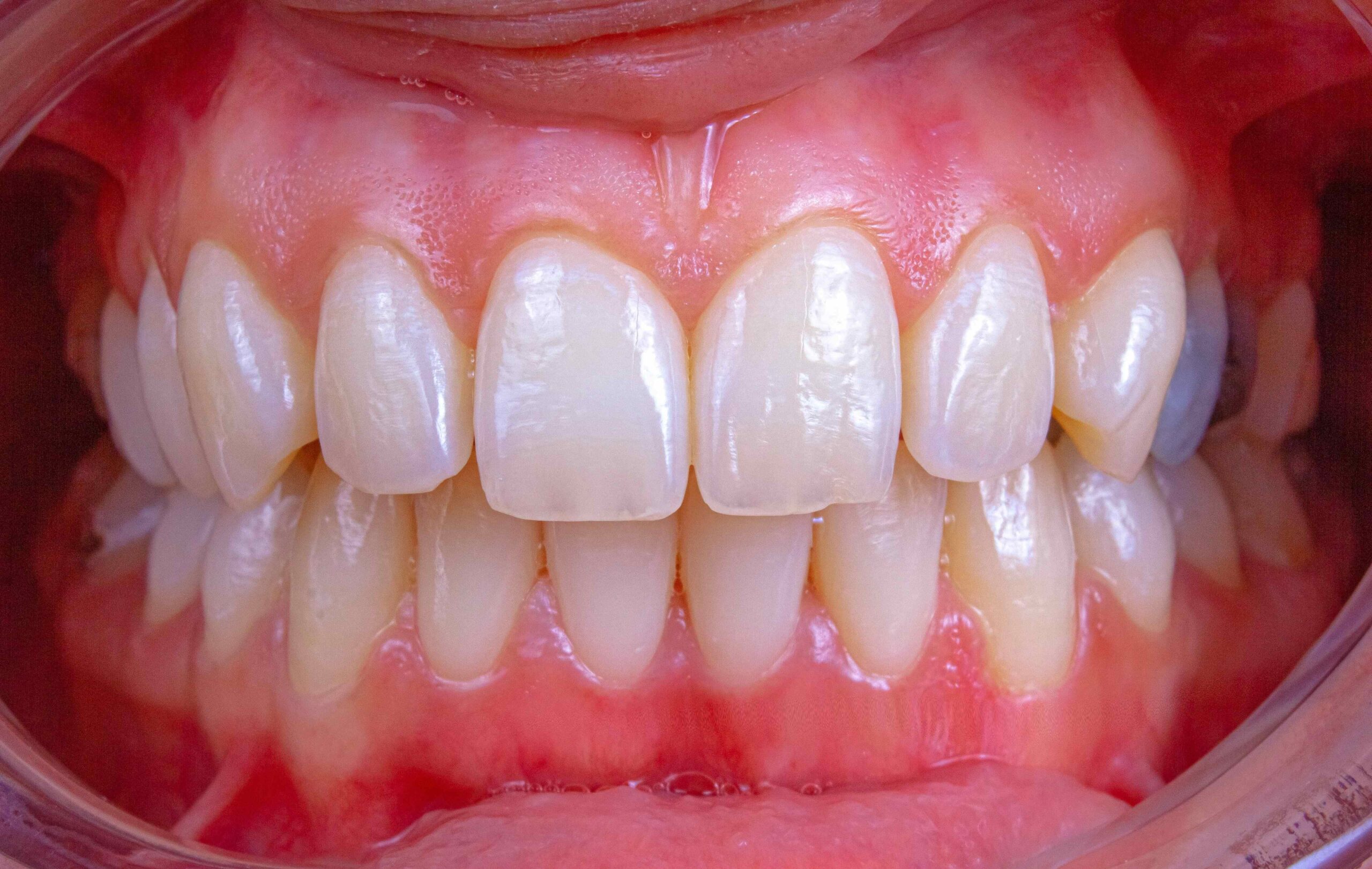 teeth and gums