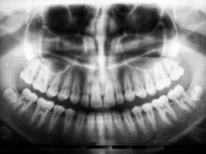 x-rays of wisdom tooth removal