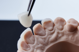 dental bonding