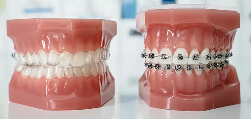Photo of two treatment options side-by-side. One is a model of clear aligners, which are subtle in appearance, a thin, transparent mold to gradually realign teeth. Next to it is a model of traditional braces, which use a system of metal brackets and wire to correct tooth position.